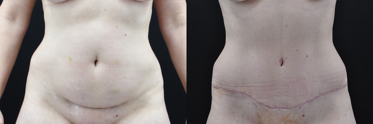 Abdominoplasty Before & After Gallery - Patient 299661 - Image 1