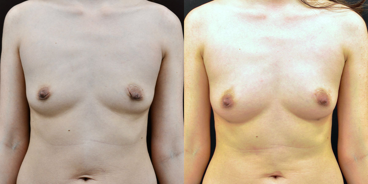 Fat Transfer/Fat Grafting Before & After Gallery - Patient 478381 - Image 1