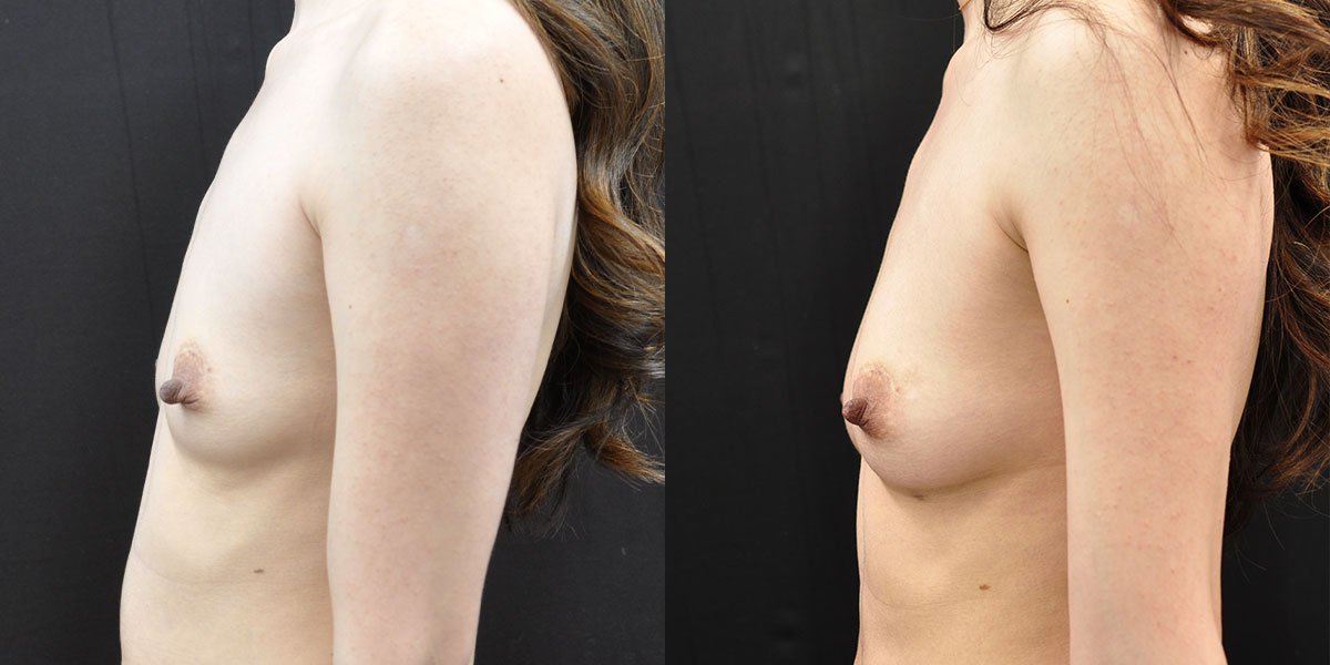 Breast Augmentation Before & After Gallery - Patient 280499 - Image 2