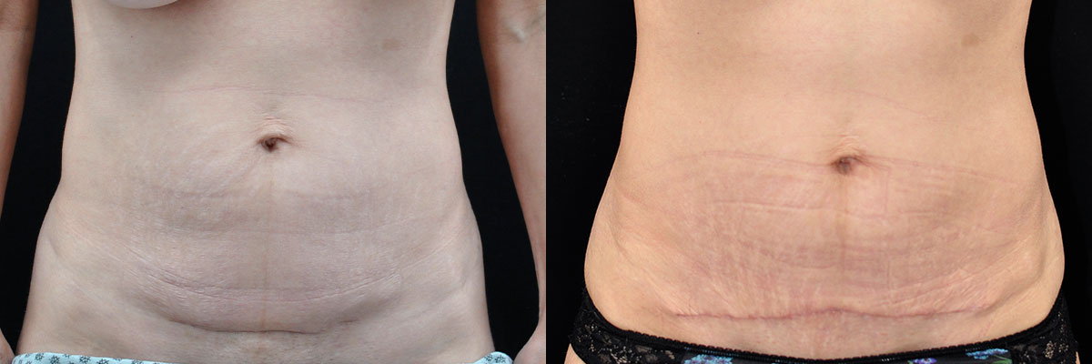 Abdominoplasty Before & After Gallery - Patient 305010 - Image 1