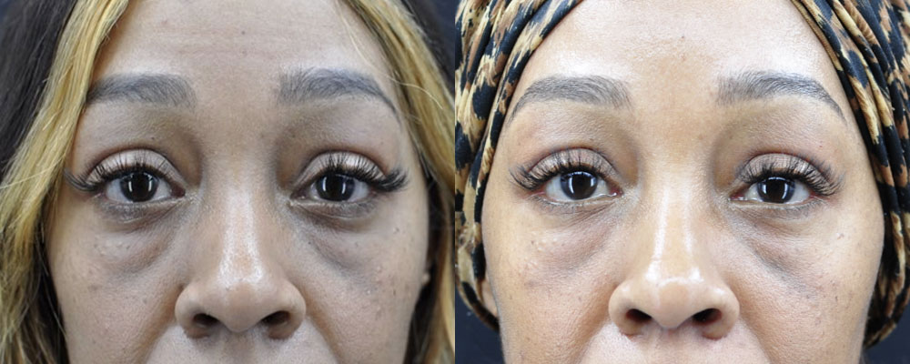 Blepharoplasty (Eyelid Surgery) Before & After Gallery - Patient 867127 - Image 1