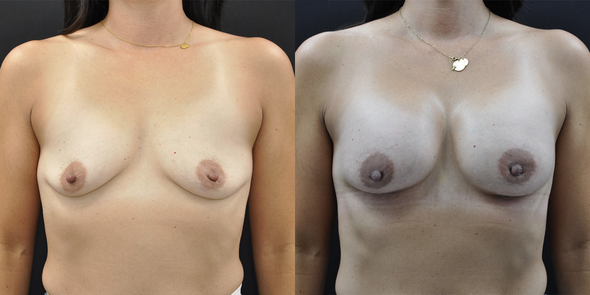 Breast Augmentation Before & After Gallery - Patient 116254 - Image 1