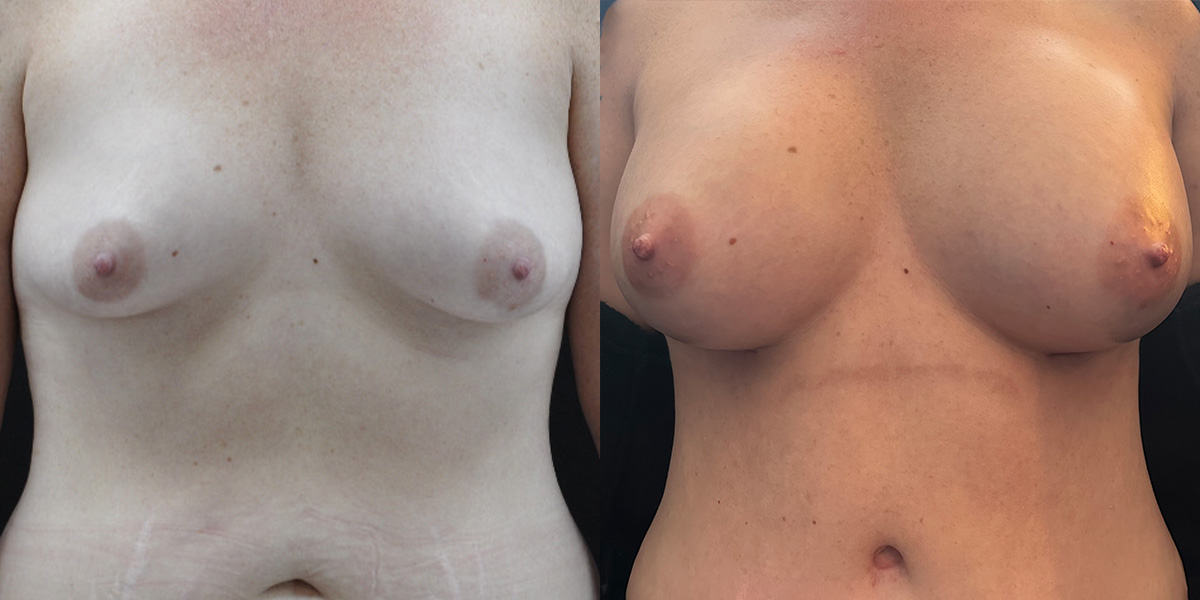Breast Augmentation Before & After Gallery - Patient 189083 - Image 1