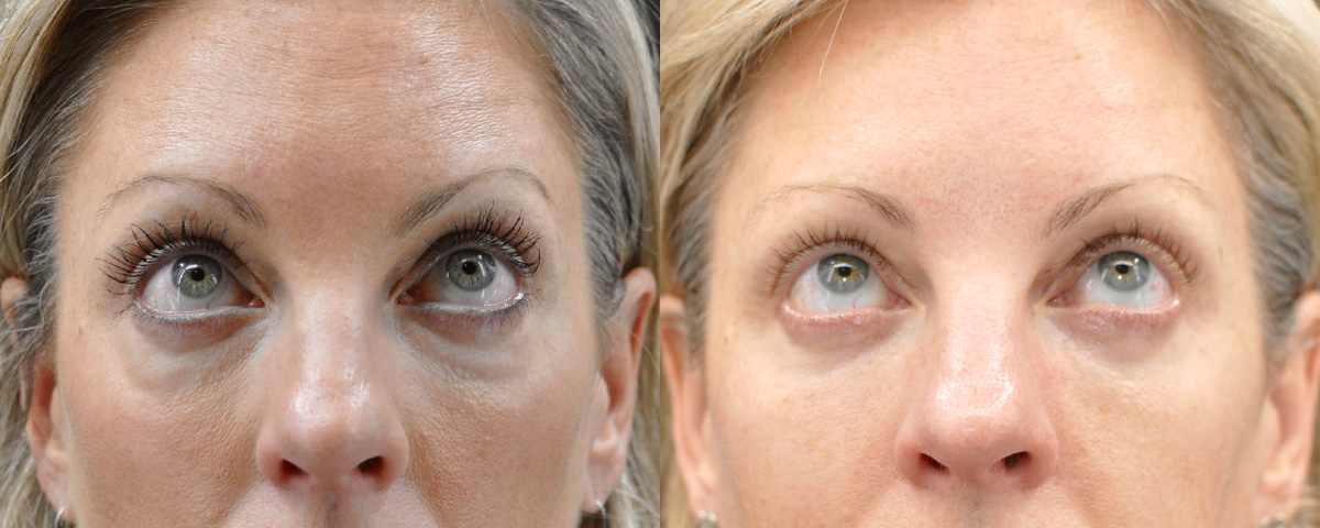 Blepharoplasty (Eyelid Surgery) Before & After Gallery - Patient 358001 - Image 2