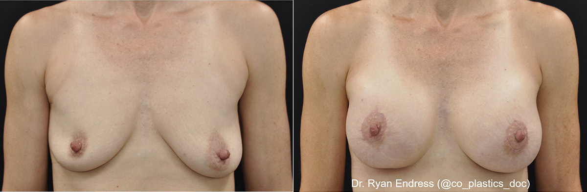 Breast Augmentation Before & After Gallery - Patient 282597 - Image 1