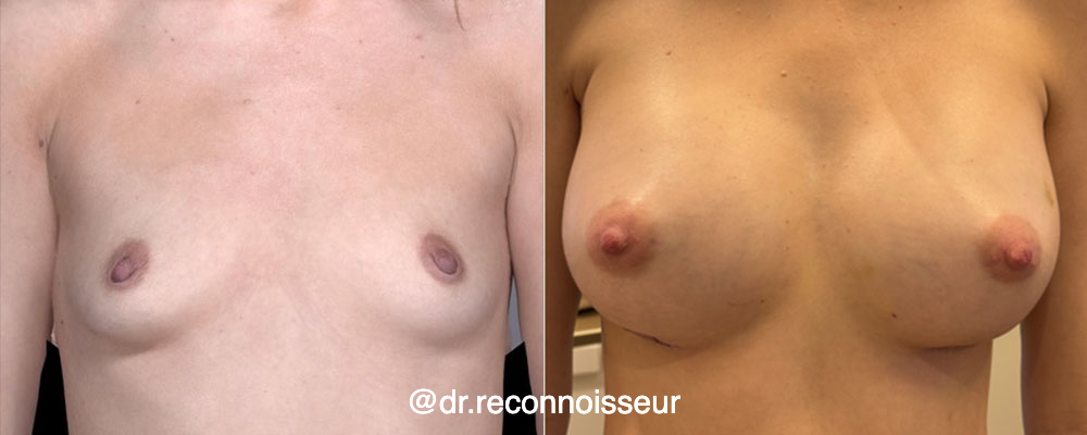 Breast Augmentation Before & After Gallery - Patient 198725 - Image 1
