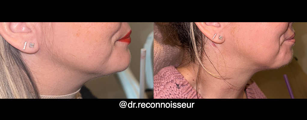 Neck Lift - Neck Vaser Lipo Before & After Gallery - Patient 133945 - Image 1