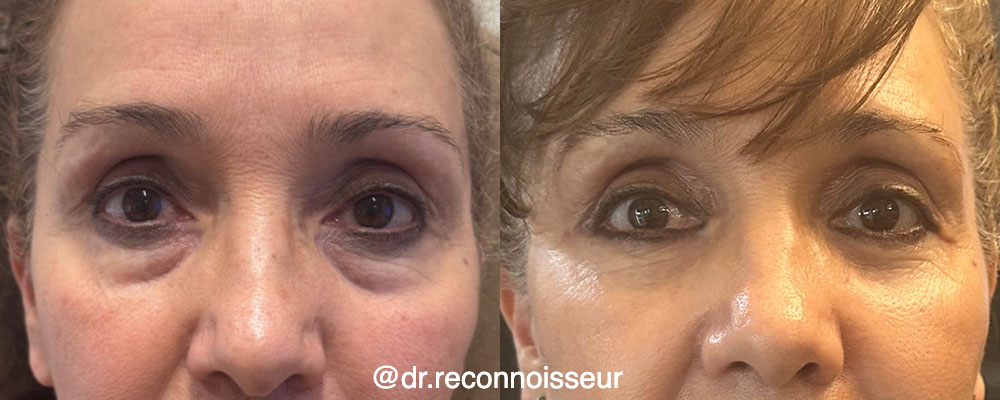 Blepharoplasty (Eyelid Surgery) Before & After Gallery - Patient 236026 - Image 1