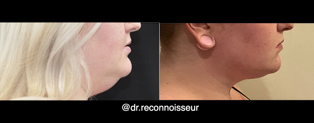 Neck Lift - Neck Vaser Lipo Before & After Gallery - Patient 931237 - Image 1