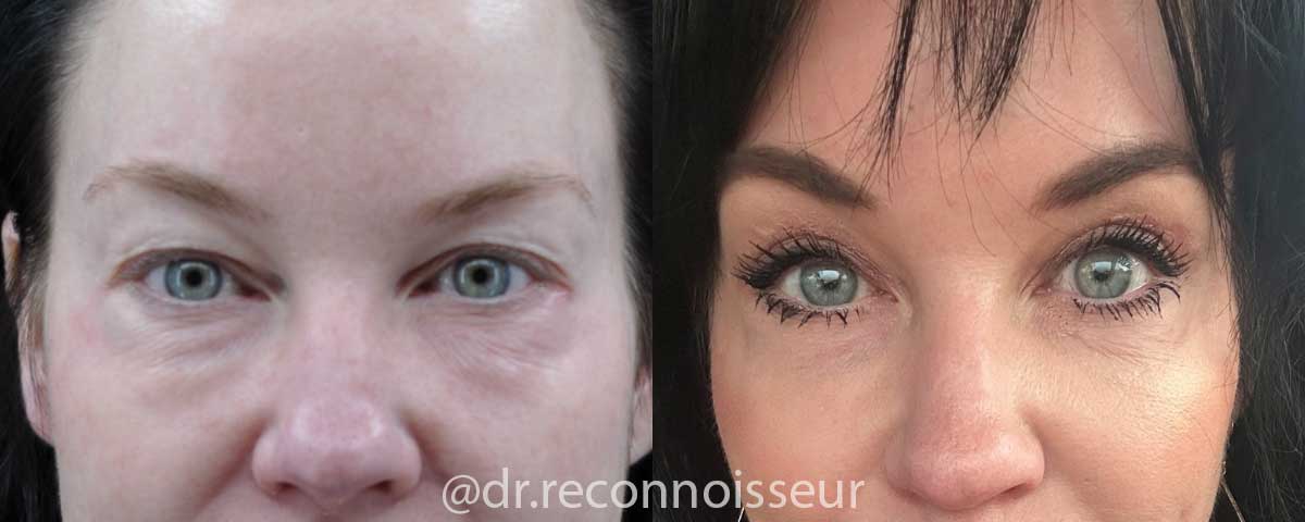 Blepharoplasty (Eyelid Surgery) Before & After Gallery - Patient 179763 - Image 1