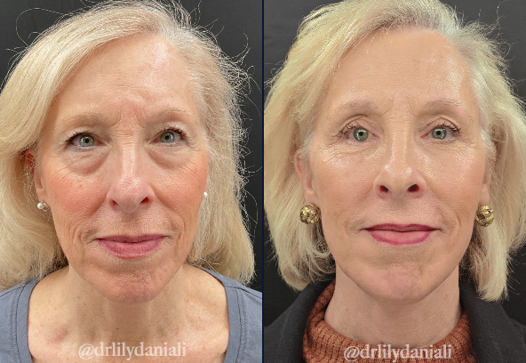 Facelift Before & After Gallery - Patient 248134 - Image 1