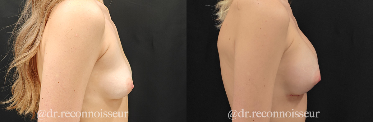 Breast Augmentation Before & After Gallery - Patient 229614 - Image 4