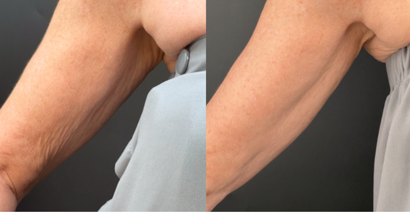 before and after image of sofwave on right arm