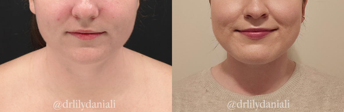 Neck Lift - Neck Vaser Lipo Before & After Gallery - Patient 396741 - Image 3