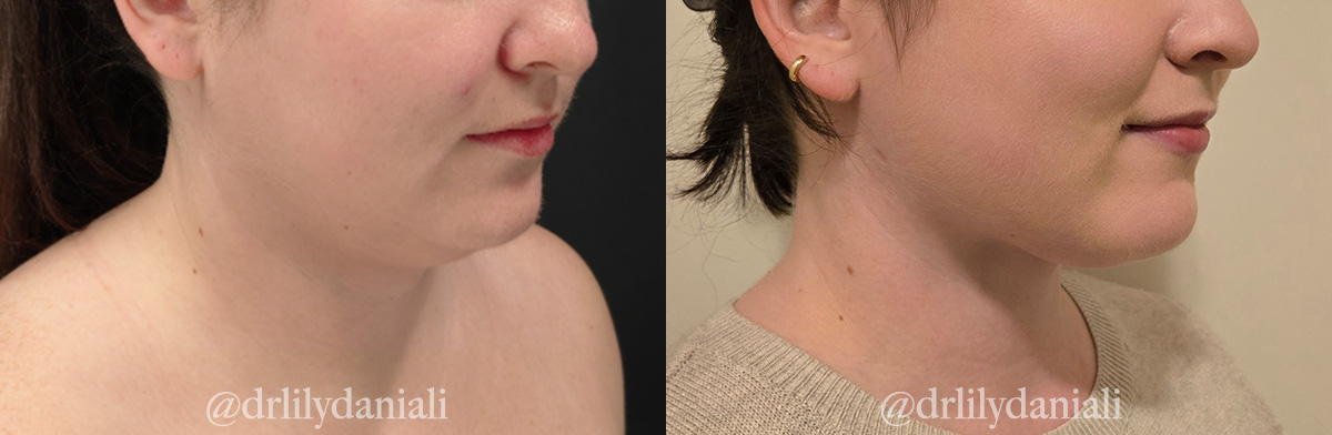 Neck Lift - Neck Vaser Lipo Before & After Gallery - Patient 396741 - Image 2