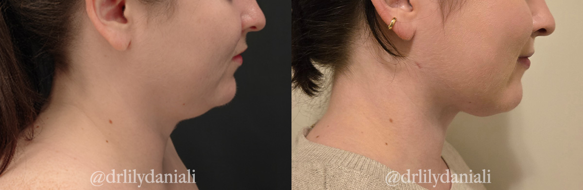 Neck Lift - Neck Vaser Lipo Before & After Gallery - Patient 396741 - Image 1