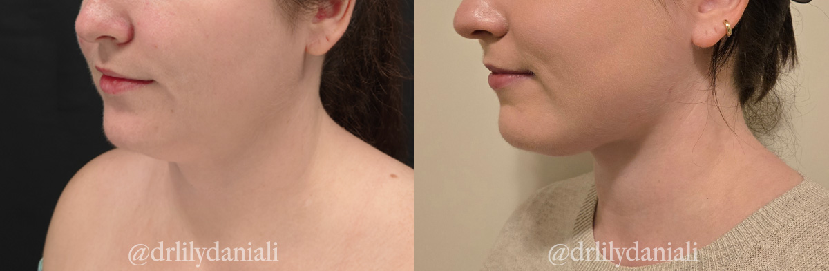 Neck Lift - Neck Vaser Lipo Before & After Gallery - Patient 396741 - Image 4