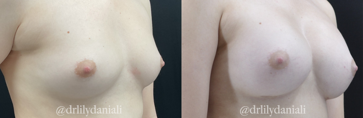 Breast Augmentation Before & After Gallery - Patient 192975 - Image 2