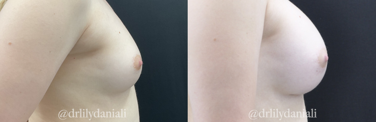 Breast Augmentation Before & After Gallery - Patient 192975 - Image 3
